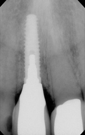 PG-ImplantCrowns-6b