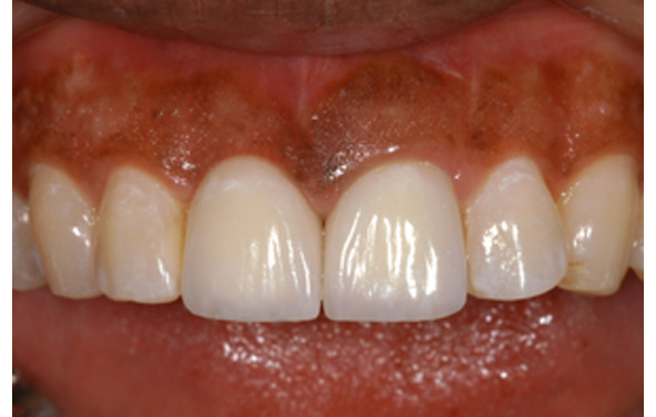 PG-ImplantCrowns-6c