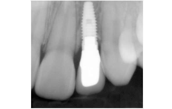 PG-ImplantCrowns-7a