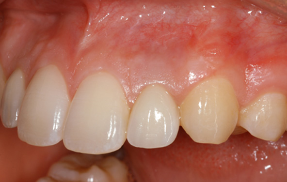 PG-ImplantCrowns-7b