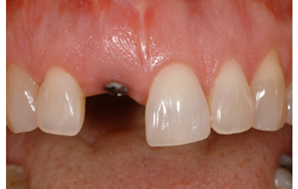 PG-ImplantCrowns-8a