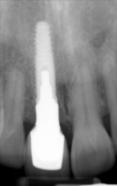 PG-ImplantCrowns-8b