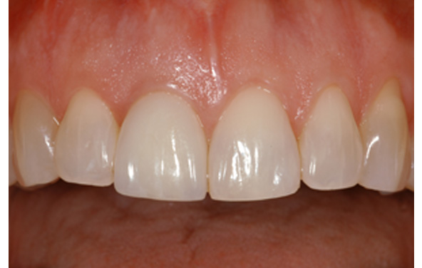 PG-ImplantCrowns-8c
