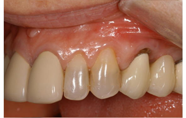 PG-ImplantCrowns-9a