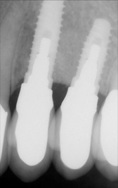 PG-ImplantCrowns-9b