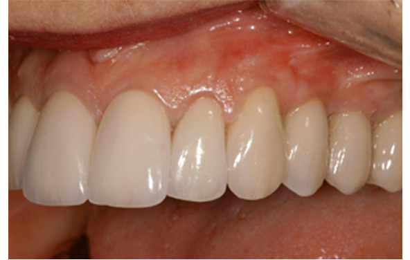 PG-ImplantCrowns-9c
