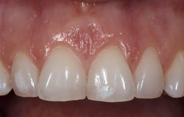 PG-PorcelainVeneers-4a