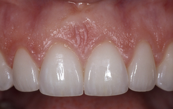 PG-PorcelainVeneers-4b