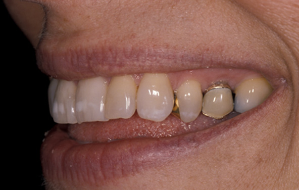 PG-PorcelainVeneers-5a