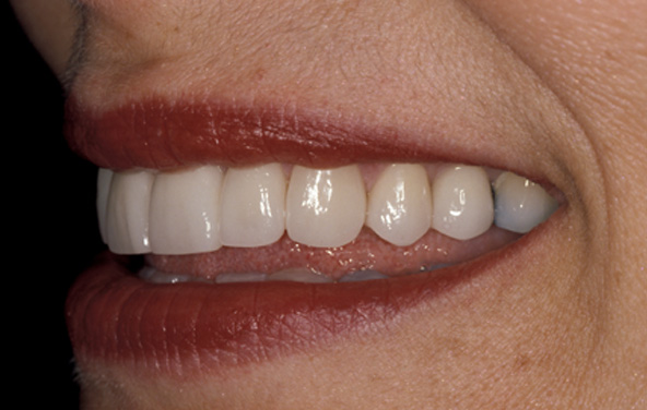 PG-PorcelainVeneers-5b